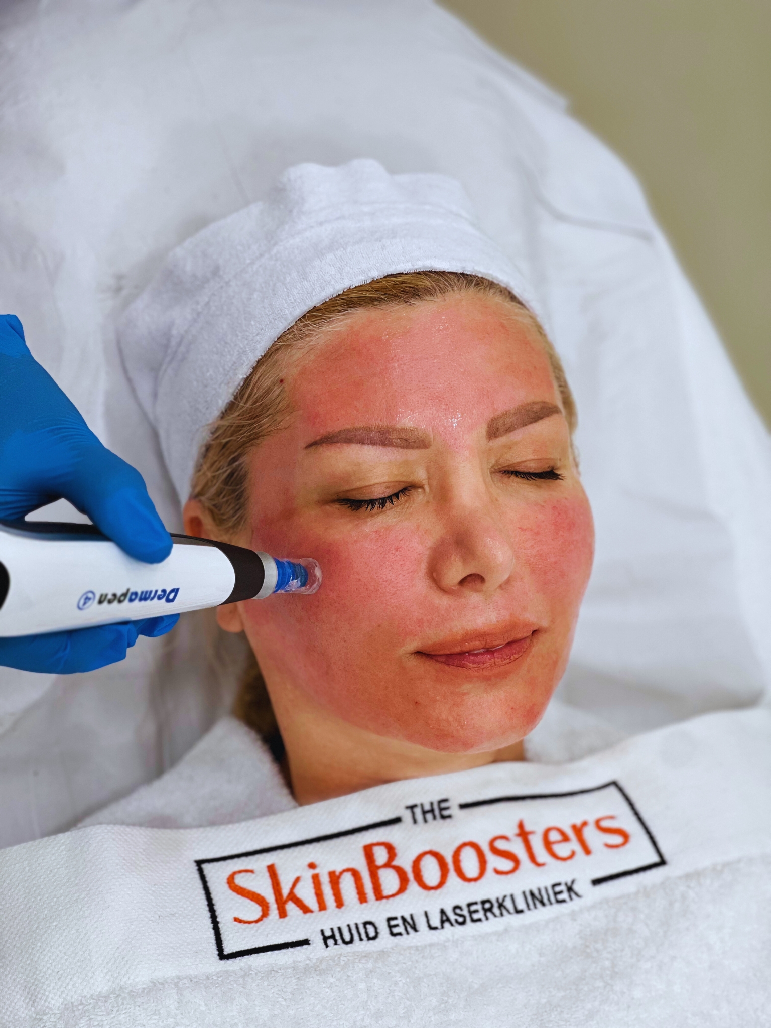 TheSkinBoosters Microneedling Dan1