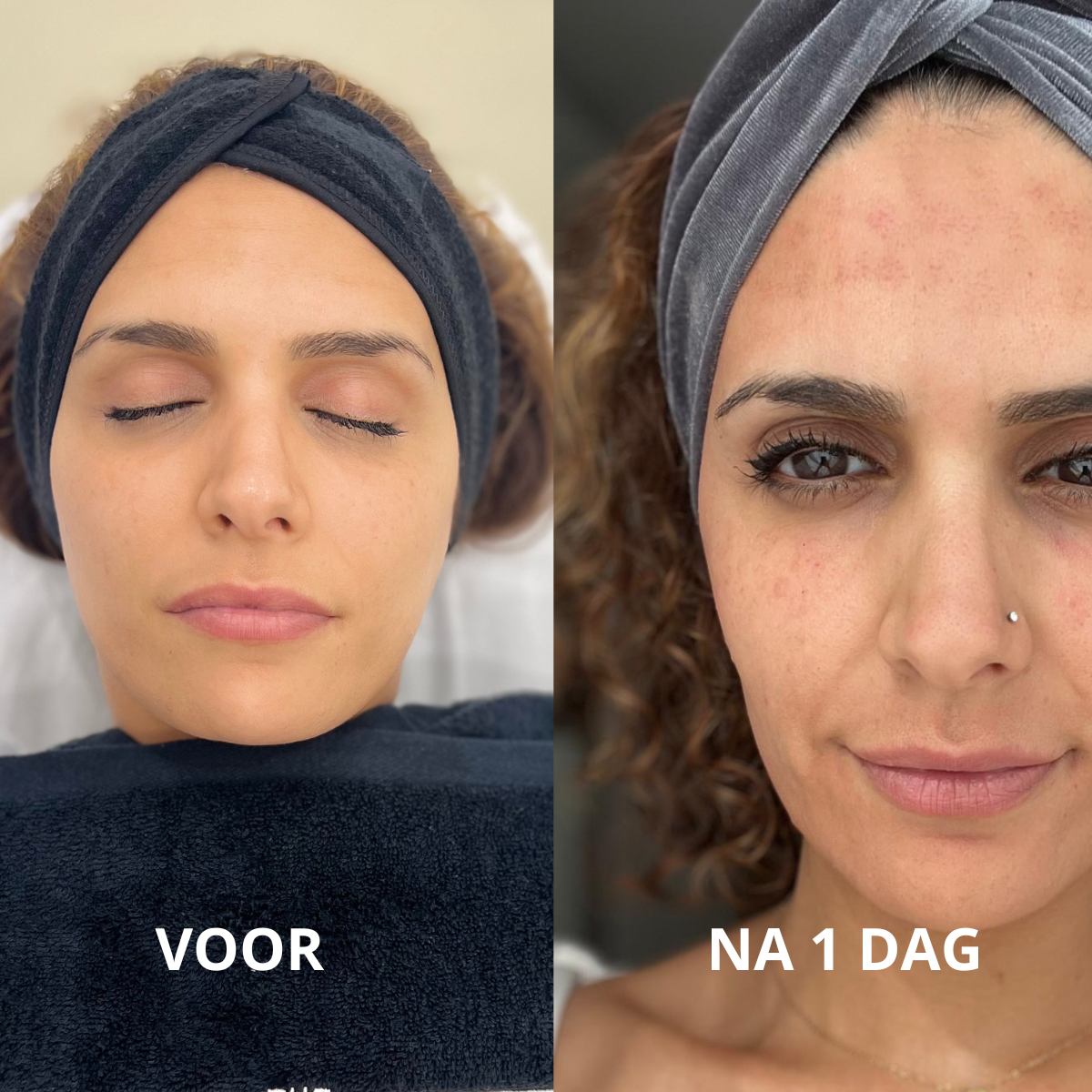 TSB Website foto square Before After Exosomen Dermapen Lat1